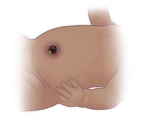 臍帯断端の周囲の腹部に炎症が見られる赤ちゃんの腹部の拡大図。