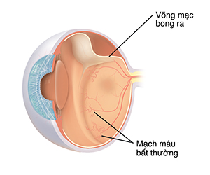 Mặt cắt ngang ba phần tư của mắt cho thấy bệnh võng mạc do sinh non.