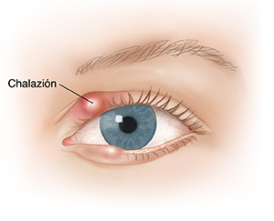 Vista frontal de un ojo con chalazión.