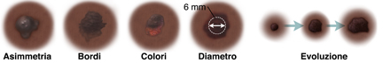Neo dalla forma asimmetrica. Neo con bordi irregolari e sfocati. Neo con macchie scure e chiare. Neo con diametro da 6 mm. Tre nei che mostrano i loro cambiamenti nel tempo.
