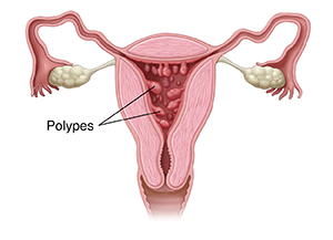 Coupe transversale antérieure du système reproducteur féminin montrant des polypes dans l'utérus.