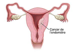 Coupe transversale antérieure du système reproducteur féminin montrant un cancer dans l'utérus.
