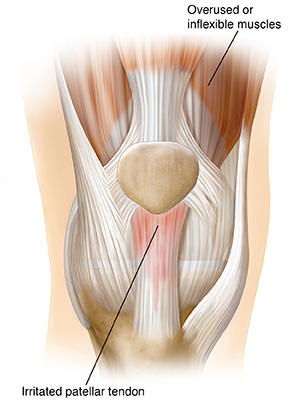 Front view of knee joint showing inflamed patellar tendon.