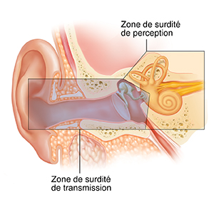 Coupe transversale d'une oreille montrant l'oreille externe, interne et moyenne. Superposition de couleurs montrant les zones provoquant une surdité de transmission et une surdité de perception.