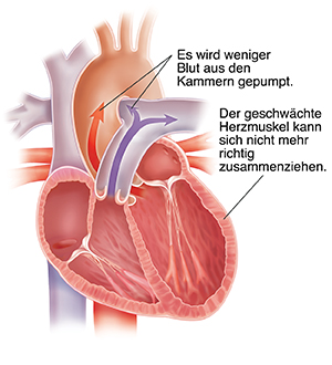 Querschnitt eines erweiterten Herzens mit systolischer Herzinsuffizienz.