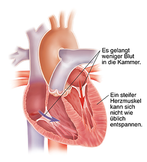 Querschnitt eines erweiterten Herzens mit diastolischer Herzinsuffizienz.
