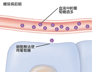 代表葡萄糖水平过高的血管和细胞的横截面,这是由糖尿病前期导致的。